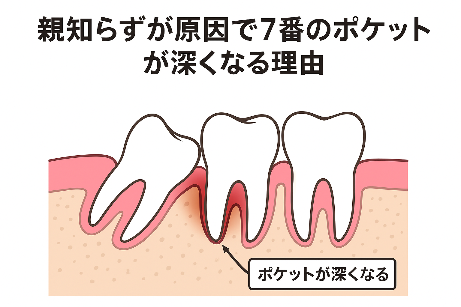 親知らずが原因で7番のポケットが深くなる理由