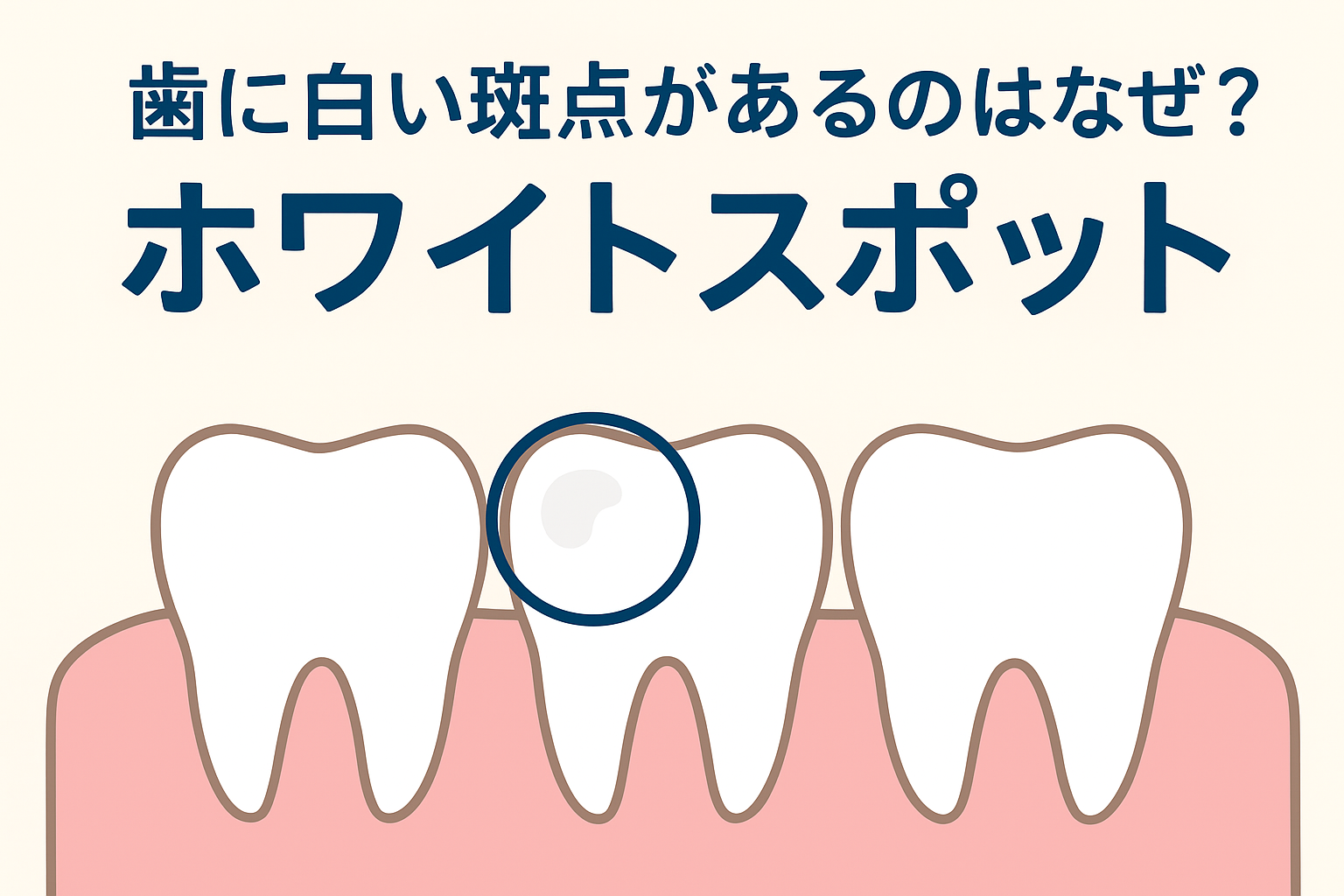 ホワイトスポットとは?🦷