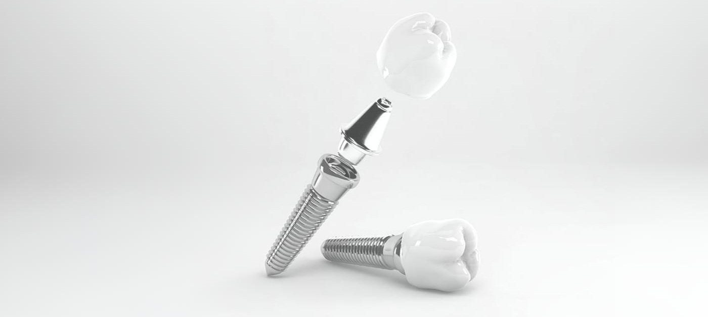 インプラントのイメージ（スマホ）