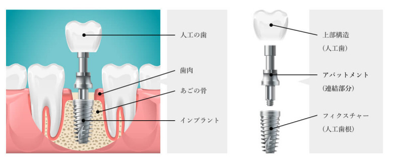 インプラントの構成解説イラスト