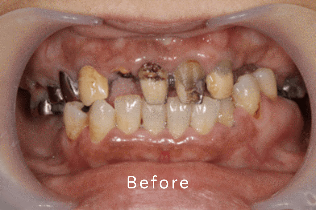 インプラント治療前の写真