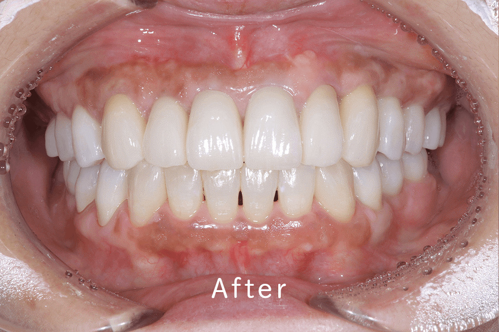 インプラント治療後の写真