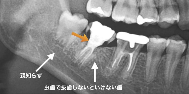 歯の移植の術前のCT写真