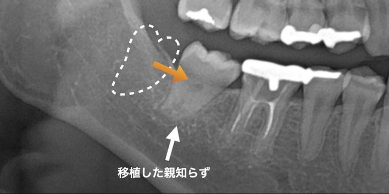 歯の移植から3年後のCT写真