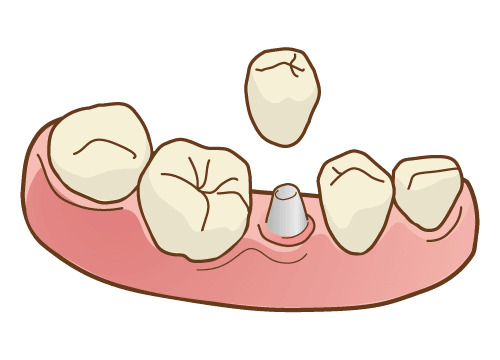 インプラント治療のイラスト