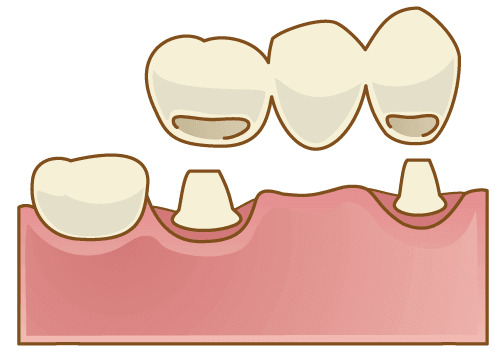 ブリッジ治療のイラスト