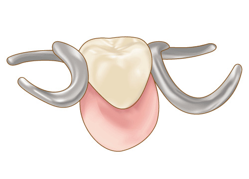 部分入れ歯のイラスト