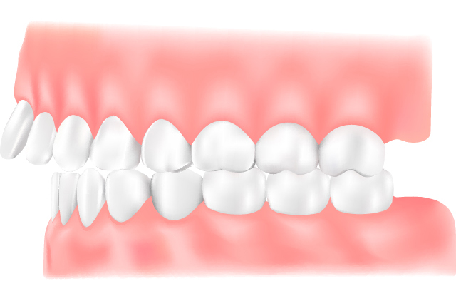 出っ歯（上顎前突）のイラスト