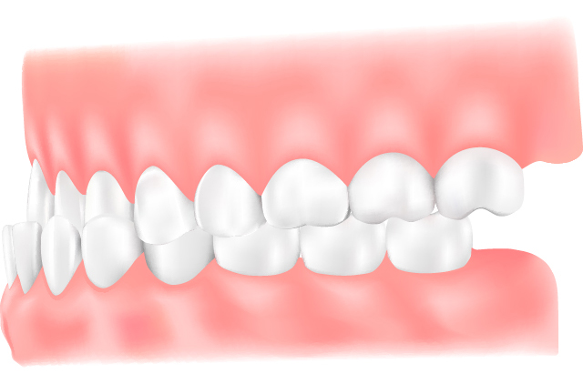 受け口（下顎前突）のイラスト
