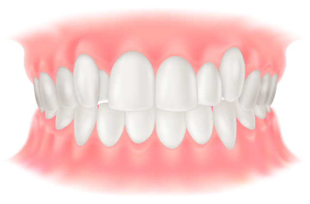 叢生（ガタガタ歯・八重歯）のイラスト