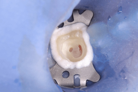 むし歯除去中の写真