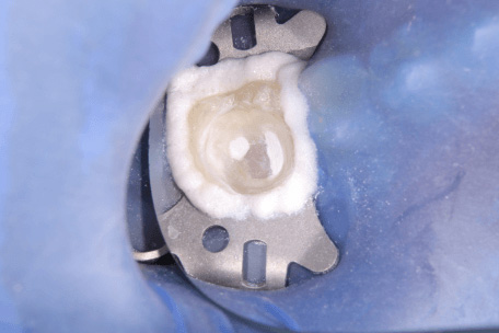 炎症を起こした歯髄の切除中の写真