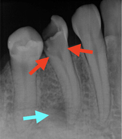 むし歯のX線写真