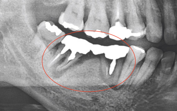 割れている神経を取った歯のX線写真