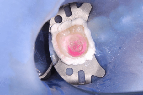 ラバーダム防湿した歯の写真