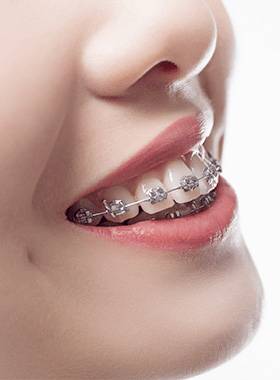 矯正装置をつけている女性の口元