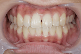 10代女性歯列矯正治療後の写真