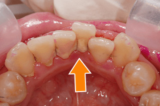 10代女性治療前、歯肉炎の写真