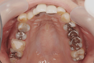 20代女性治療前、上の歯の写真