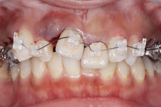 20代女性ワイヤー装着当日、前歯の写真