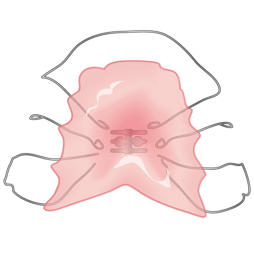 床矯正のイラスト