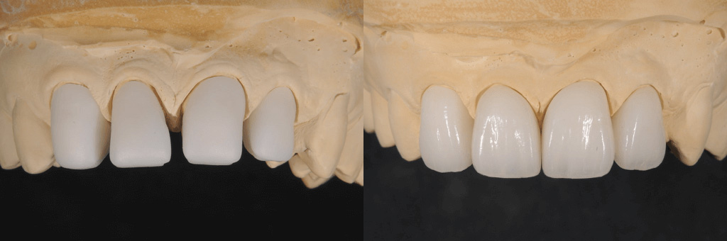 ジルコニアフレームセラミッククラウンの写真