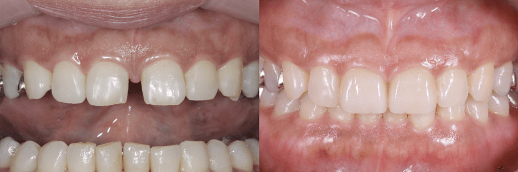 ラミネートベニアの写真