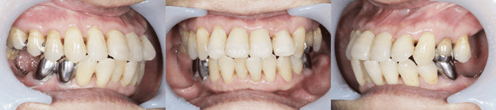 症例1人目　前歯の写真