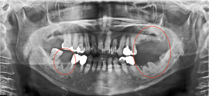 症例1人目　X線写真