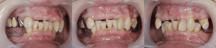 症例2人目　前歯の写真