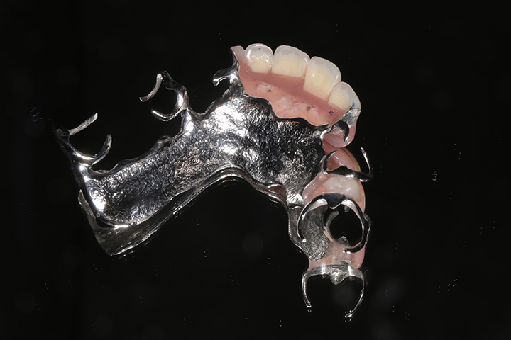 部分入れ歯の写真