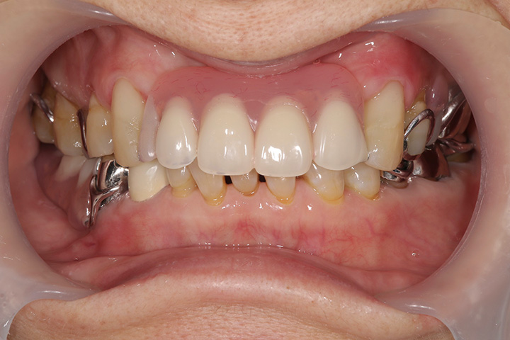 部分入れ歯を装着した写真