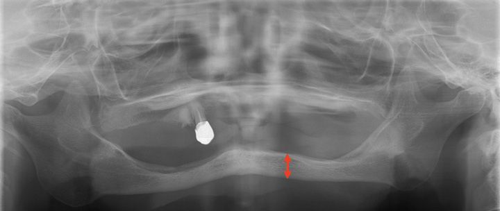 下顎の骨の厚みがないX線写真