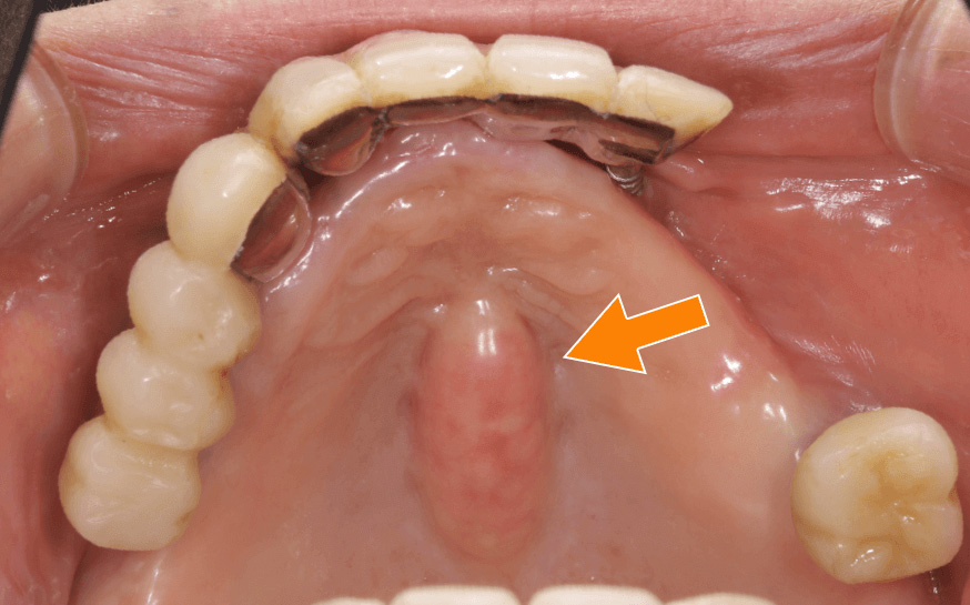 骨隆起（外骨症）の写真