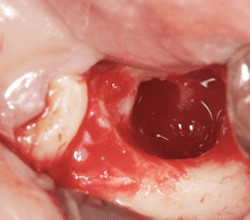 抜歯した後の状態の写真