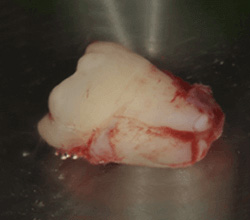 摘出した親知らずの写真