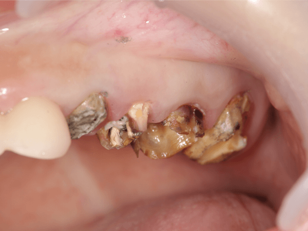かぶせ物を外すと中の歯はむし歯でボロボロになっていることがわかる