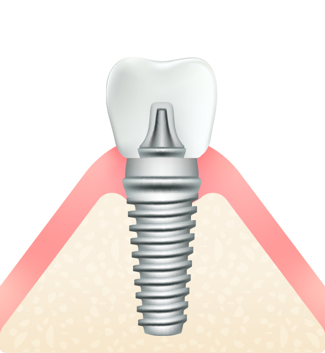 インプラントのイラスト