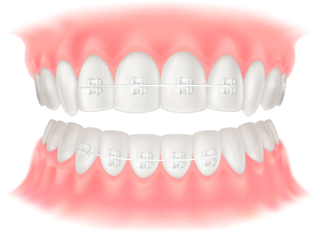 部分矯正のイラスト