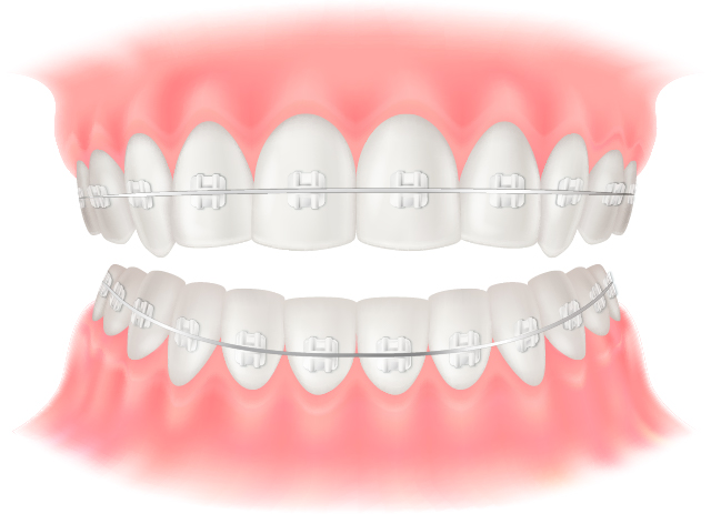 ワイヤー矯正のイラスト