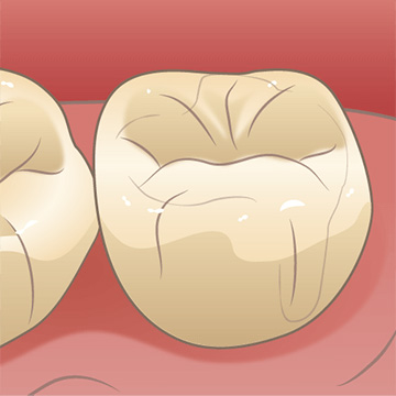 コンポジットレジン