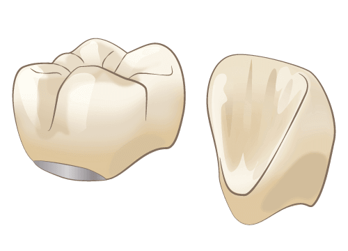 前歯部セラミッククラウン