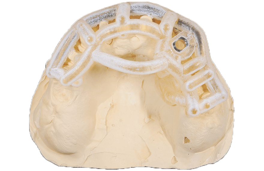 サージカルステント